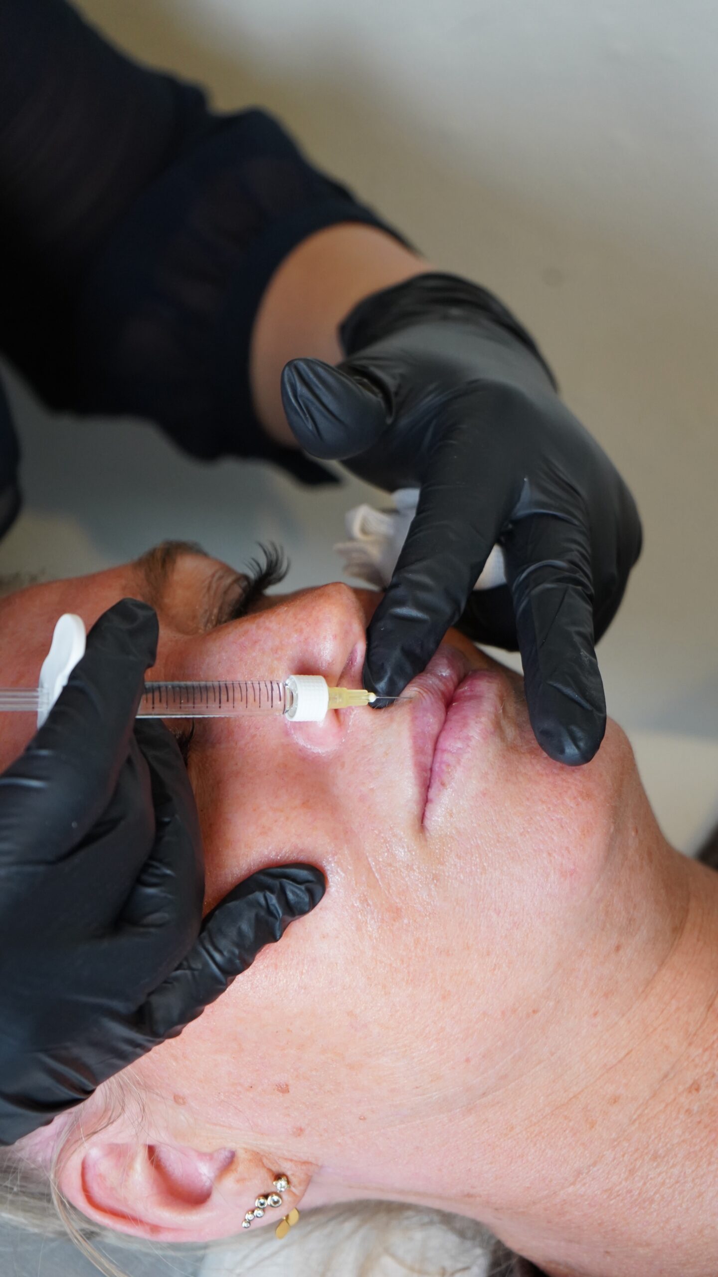 Fillerbehandling hos Dr. Wimmer Aesthetics
